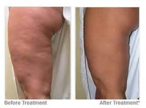 Résultats avant/après traitement de la cellulite