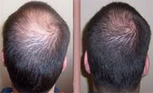 Résultats avant/après - traitement contre la chute de cheveux - institut de beauté Akhena à Bulle