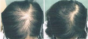 Résultats avant/après - chute de cheveux - institut de beauté Akhena à Bulle