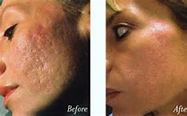 Rajeunissement de la peau - traitement de dermorestauration