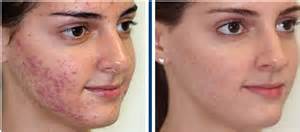 Résultats avant/après - peeling anti-acné - institut de beauté Akhena à Bulle
