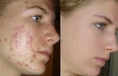 Résultats avant/après - peeling anti-acné - institut de beauté Akhena à Bulle