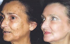 Résultats avant/après - Peeling dépigmentant - institut de beauté Akhena à Bulle
